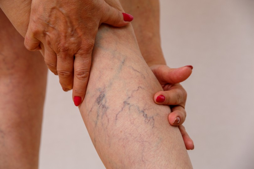 Vein Center Vein Center